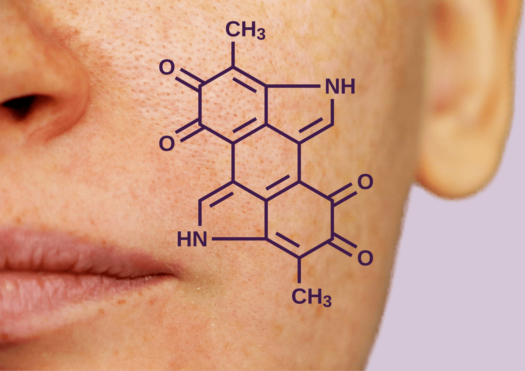 Hyperpigmentace na obličeji, způsobená melaninem - Lumiere Medispa